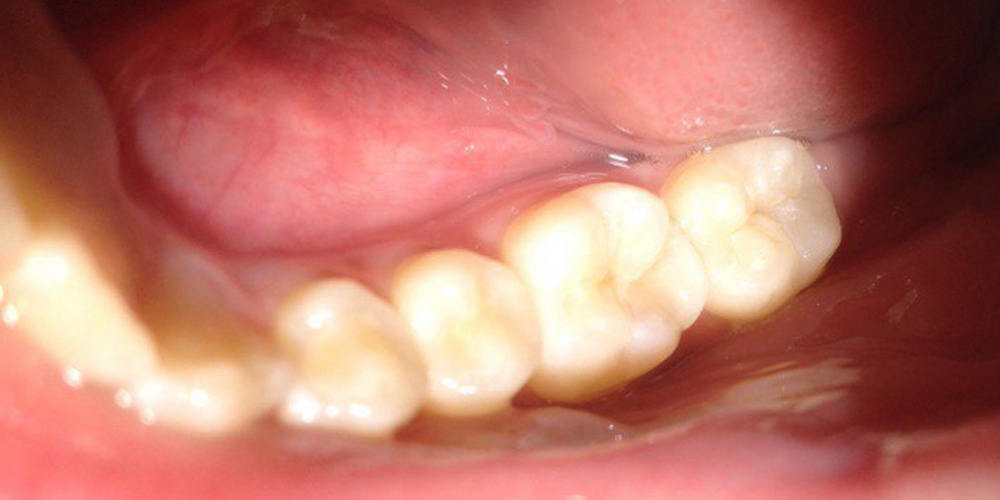 Фотография результата лечения поверхностного кариеса жевательного зуба Результат лечения поверхностного кариеса жевательного зуба