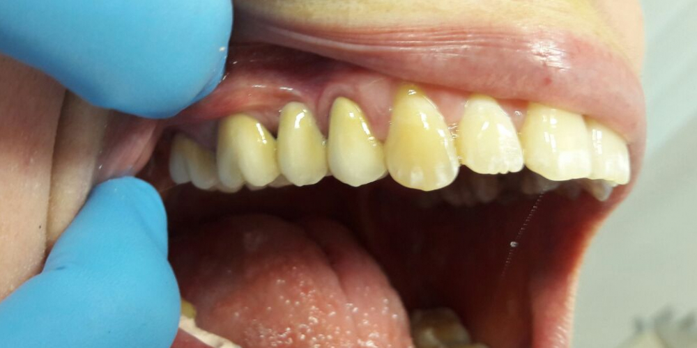  Мостовидный протез из металлокерамики на 3 зуба