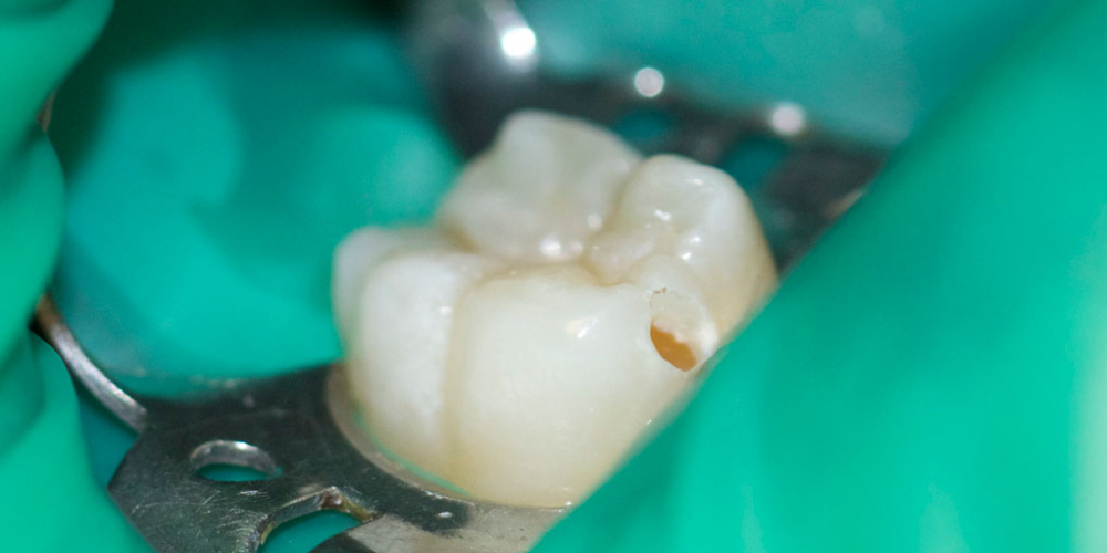  Лечение кариозного процесса на жевательном зубе нижней челюсти
