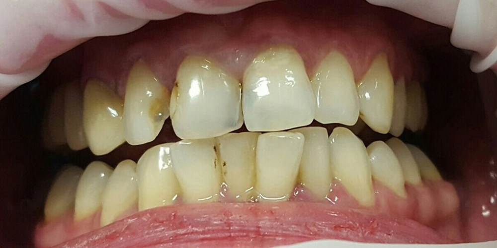  Лечение кариеса и реставрация двух передних зубов