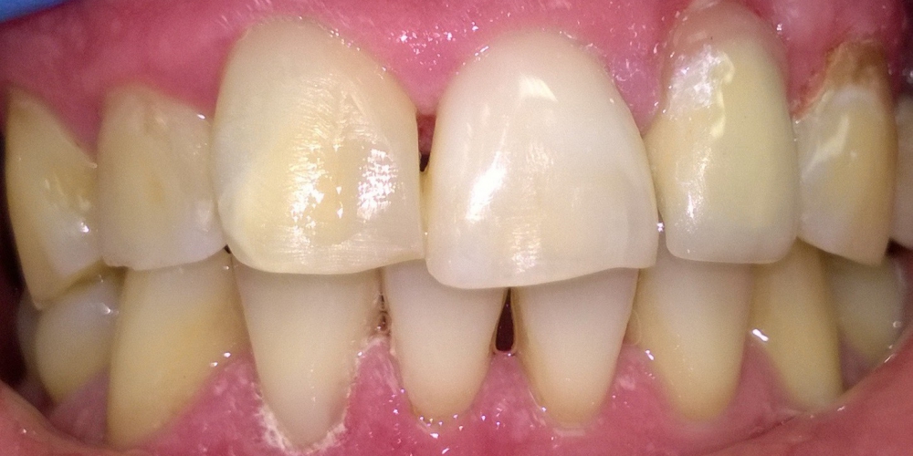 Зуб подготовлен к протезированию - восстановлен под коронку со световолоконным штифтом Жалоба на эстетический недостаток центрального резца