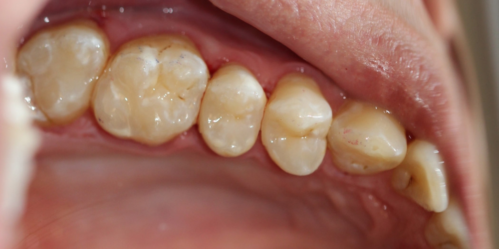  Результат лечения кариеса четырех зубов за один прием