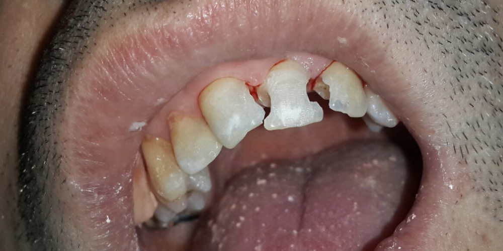  Результат восстановления передних зубов