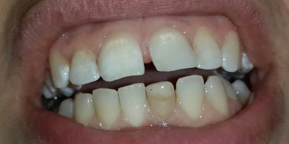  Внутриканальное отбеливание и реставрация передних зубов