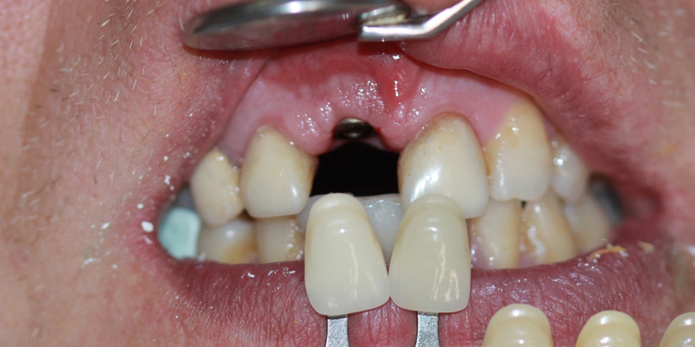  Имплантация переднего зуба и металлокерамическая коронка