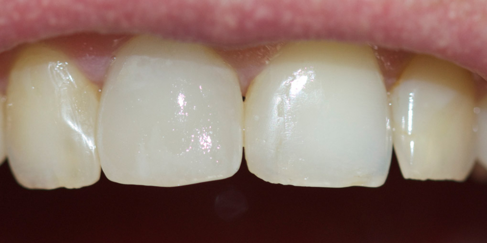  Замена ранее установленной коронки на переднем зубе