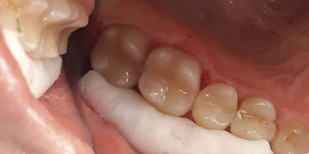  Результат эстетической реставрации жевательных зубов