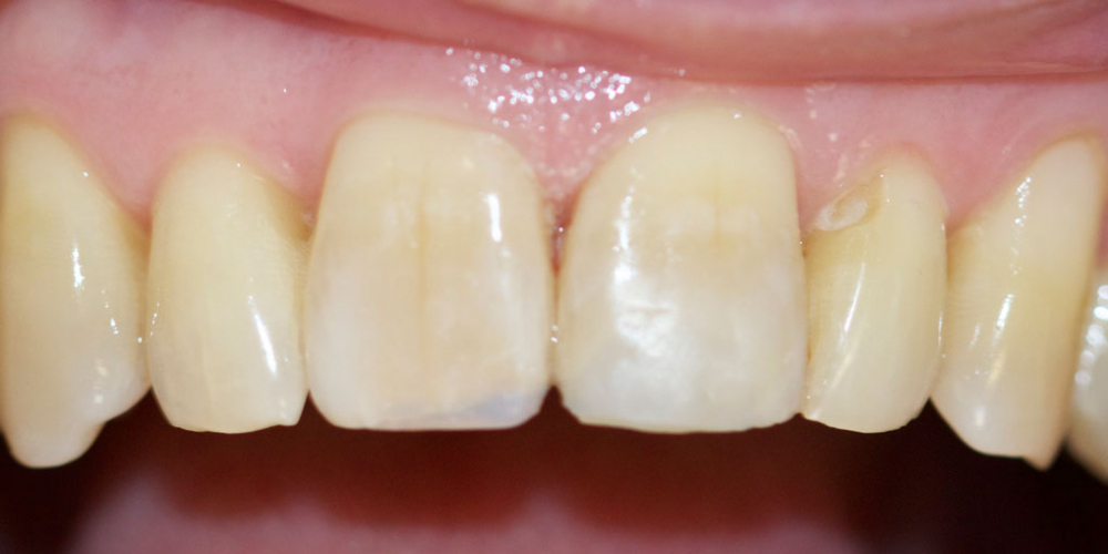  Реставрация переднего зуба композитом