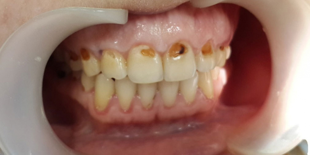  Лечение и художественная реставрация передних зубов