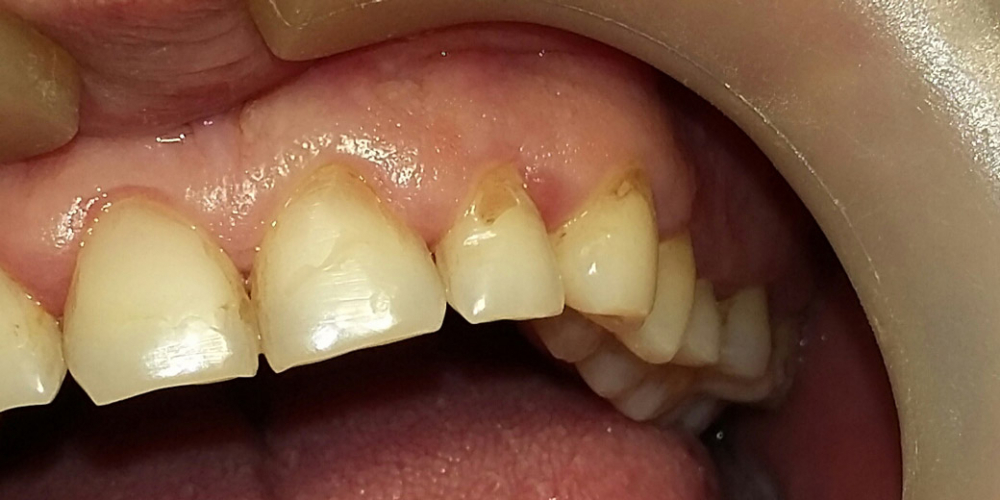  Реставрация клиновидного дефекта зубов