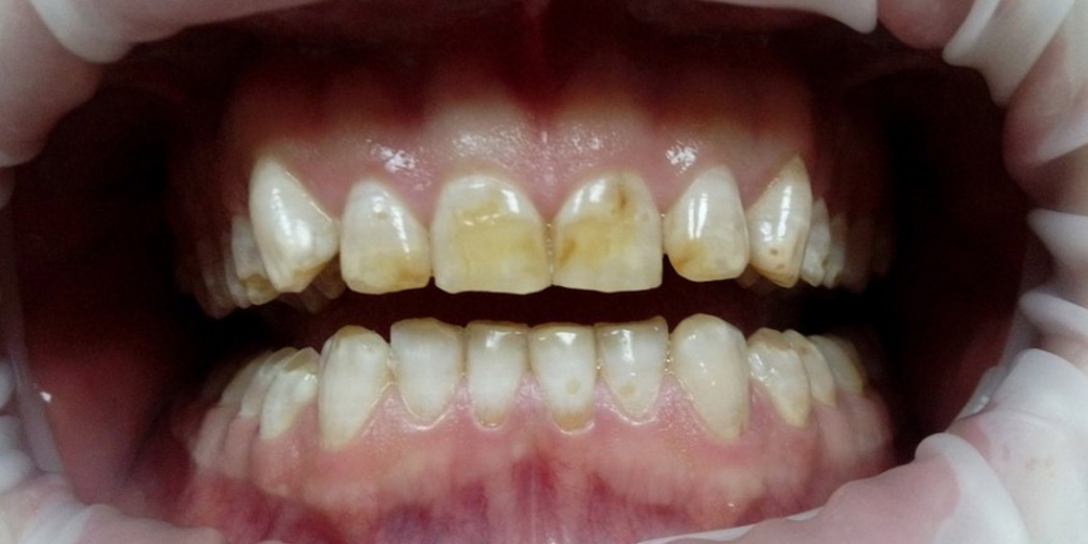  Эстетическая реставрация зубов композитными винирами