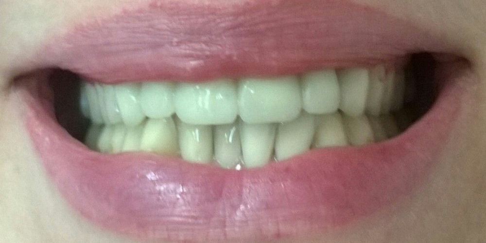 Фото с временными коронками Протезирование передних зубов цельнокерамические коронки E-Max