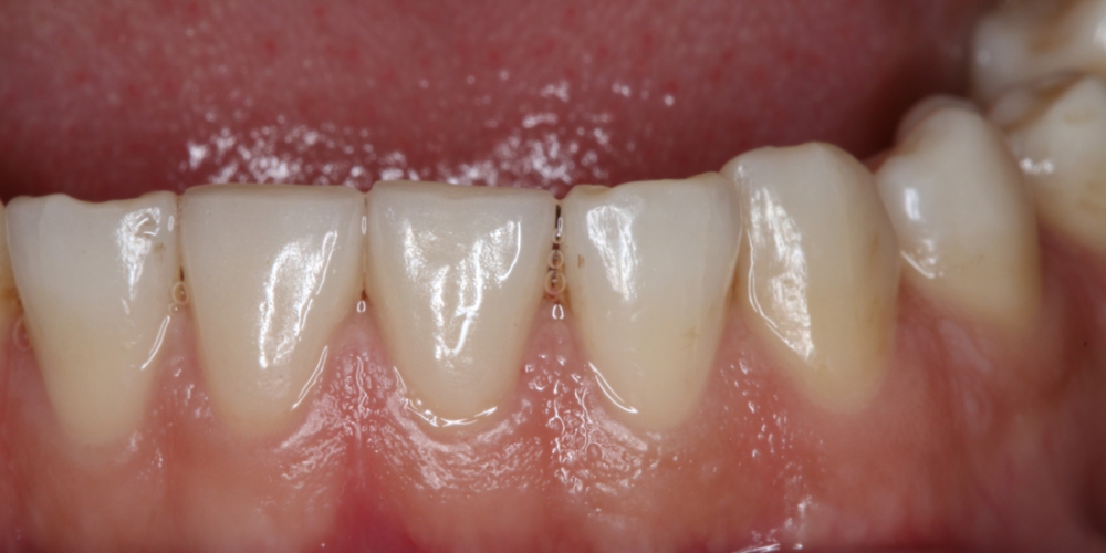  Реставрация керамическими винирами E-max (двух верхних и нижних зубов)