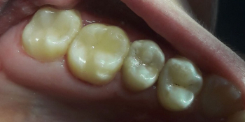 Лечение кариеса, реставрация жевательных зубов, жалоба на боль в зубах фото после лечения