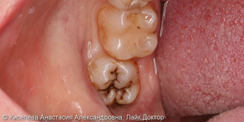 Лечение кариеса дентина 48 зуба, кратковременные боли от химических раздражителей фото до лечения