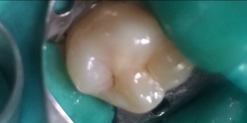 Средний кариес на жевательном зубе верхней челюсти фото после лечения