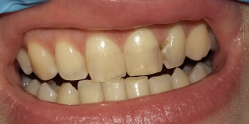 Эстетическая реставрация двух передних зубов фото до лечения
