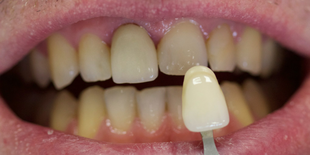  Замена ранее установленной коронки на переднем зубе