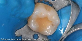Лечение кариеса зуба 36, восстановление анатомической формы фото до лечения