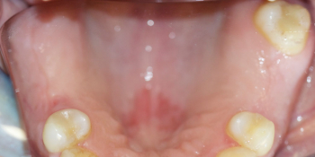 Восстановление жевательной функции зубов на нижней челюсти бюгельными протезами фото до лечения