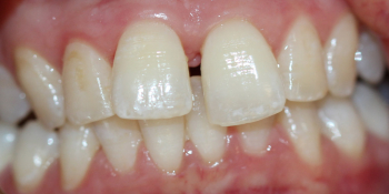 Устранение щели между зубами съемными аппаратами фото до лечения
