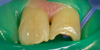 Реставрация переднего зуба композитом фото до лечения