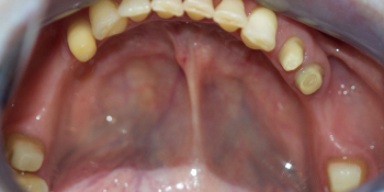 Восстановление жевательной функции зубов на нижней челюсти мостовидными протезами фото до лечения