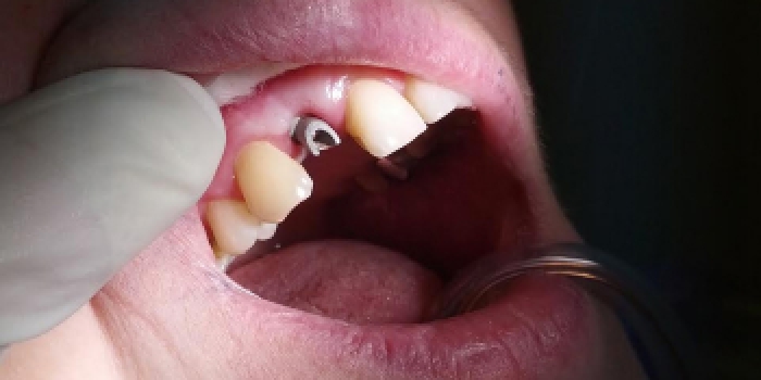Имплантация зубов Конмет, коронка из металлокерамики фото до лечения