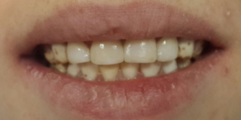 Изготовление композитных виниров на 4 передних зуба фото после лечения