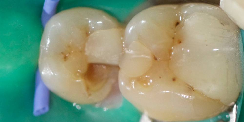  Лечение среднего кариеса на жевательном зубе нижней челюсти