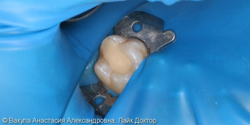 Лечение кариеса жевательного зуба фото до лечения