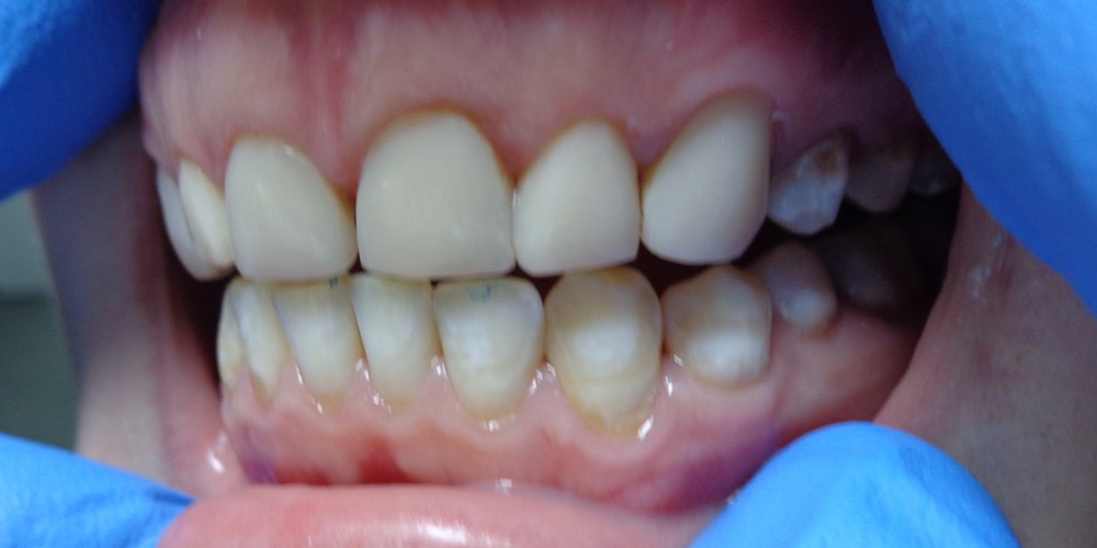  Реставрация зубов композитными винирами