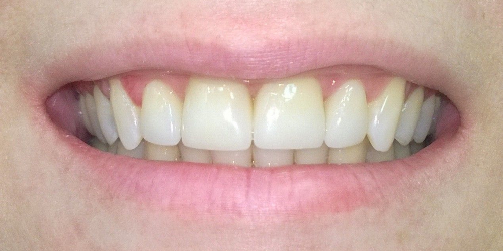 Результат Цельнокерамические коронки e-max на передние зубы