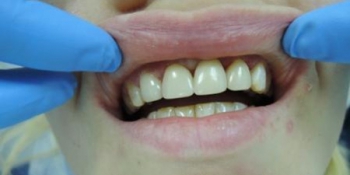 Эстетическая реставрация зубов, поврежденных флюорозом фото после лечения