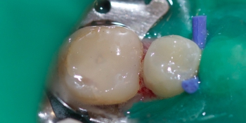 Результат лечения сколовшегося зуба фото после лечения