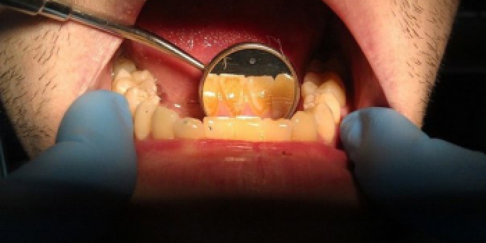 Профессиональная чистка зубов (дентикюр) с применением процедуры Air-Flow фото до лечения