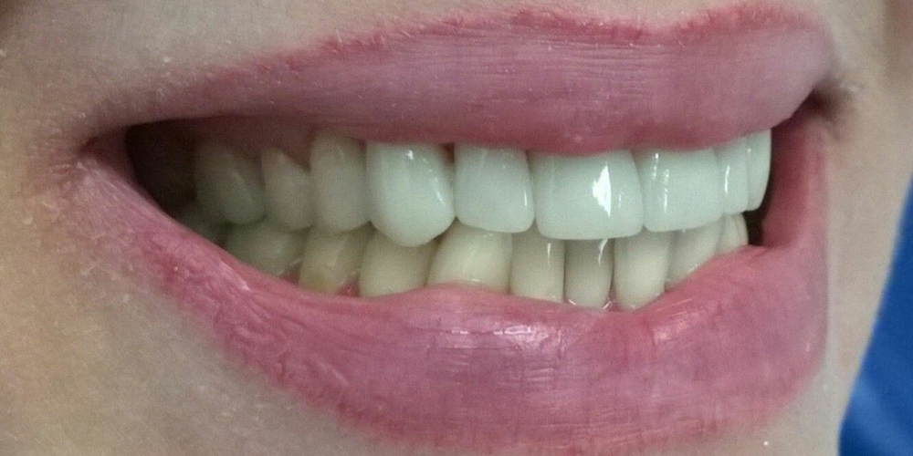 Сразу после фиксации коронок Протезирование передних зубов цельнокерамические коронки E-Max