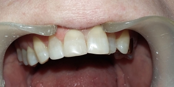 Реставрация скола переднего зуба фото после лечения