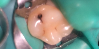 Средний кариес на жевательном зубе верхней челюсти фото до лечения