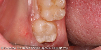 Лечение кариеса дентина 48 зуба, кратковременные боли от химических раздражителей фото после лечения