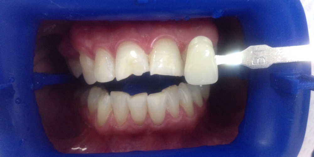  Отбеливание зубов Zoom AP с последующей реставрацией переднего зуба