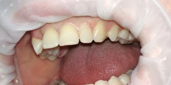 Эстетическая реставрация зубов в линии улыбки фото после лечения