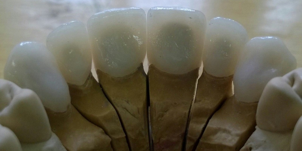 Коронки на моделях Протезирование передних зубов цельнокерамические коронки E-Max