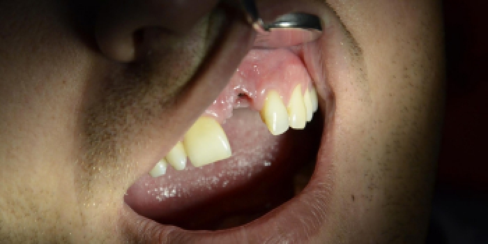 Одномоментная имплантация зубов по системе Astra-Tech с последующим протезированием фото до лечения