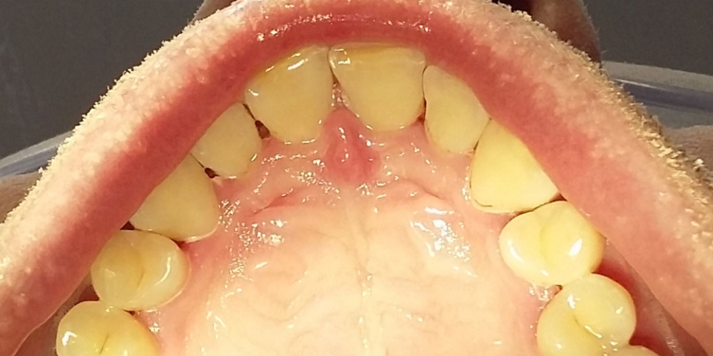Верхняя челюсть фото после профессиональной чистки зубов. Результат профессиональной гигиены полости рта