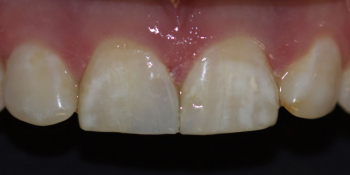 Ремонт скола центрального зуба верхней челюсти фото после лечения