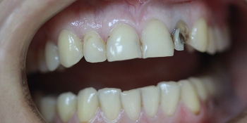 Серебрение зубов у детей - в вопросах и ответах