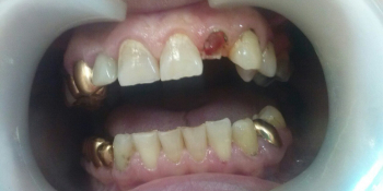 Протезирование зуба с помощью одиночной коронки из диоксида циркония Prettau фото до лечения