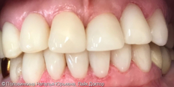 Эстетическая реставрация зубов фото после лечения