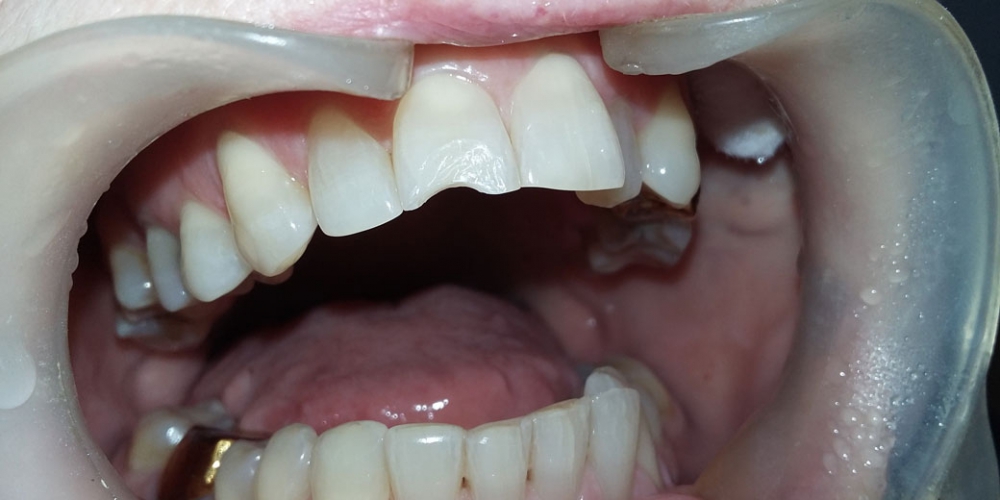Второе фото - в процессе работы (процесс препарирования зуба). Реставрация скола переднего зуба